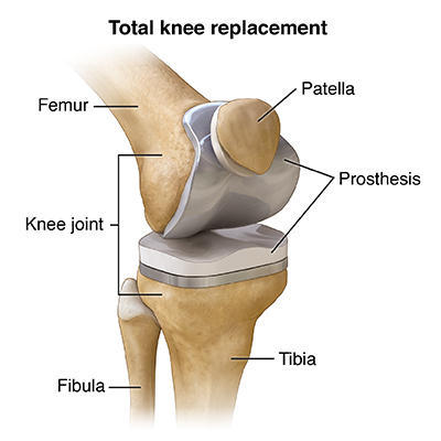 Hip Replacement Illustration
